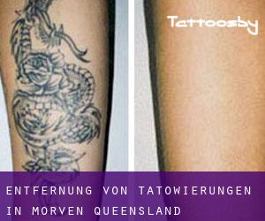 Entfernung von Tätowierungen in Morven (Queensland)