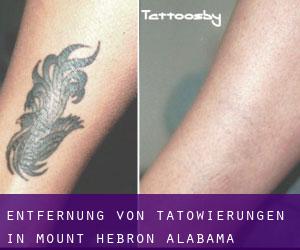 Entfernung von Tätowierungen in Mount Hebron (Alabama)