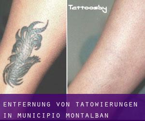 Entfernung von Tätowierungen in Municipio Montalbán