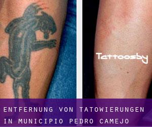 Entfernung von Tätowierungen in Municipio Pedro Camejo