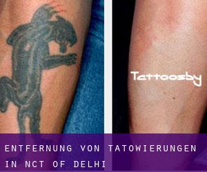 Entfernung von Tätowierungen in NCT of Delhi