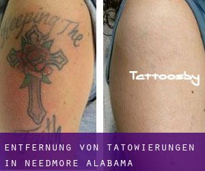 Entfernung von Tätowierungen in Needmore (Alabama)