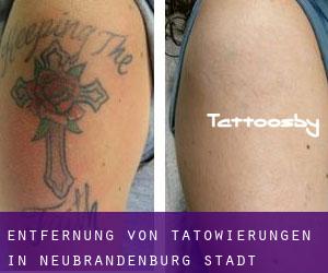 Entfernung von Tätowierungen in Neubrandenburg Stadt