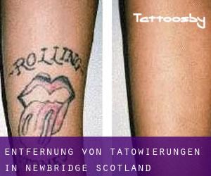 Entfernung von Tätowierungen in Newbridge (Scotland)