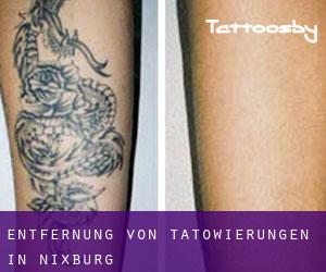 Entfernung von Tätowierungen in Nixburg
