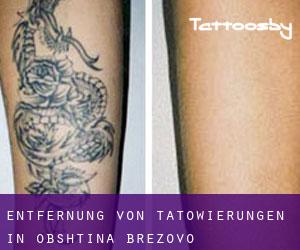 Entfernung von Tätowierungen in Obshtina Brezovo