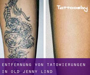Entfernung von Tätowierungen in Old Jenny Lind