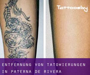 Entfernung von Tätowierungen in Paterna de Rivera