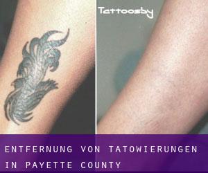 Entfernung von Tätowierungen in Payette County