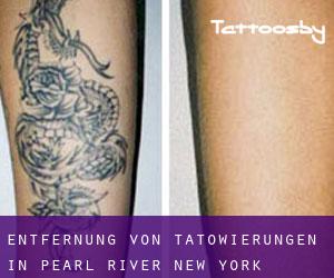 Entfernung von Tätowierungen in Pearl River (New York)