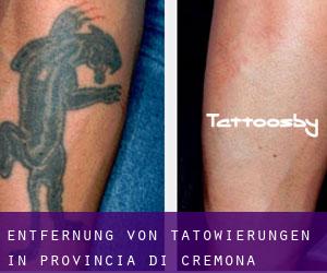 Entfernung von Tätowierungen in Provincia di Cremona