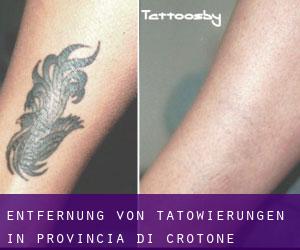 Entfernung von Tätowierungen in Provincia di Crotone