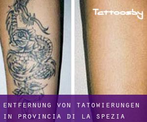 Entfernung von Tätowierungen in Provincia di La Spezia