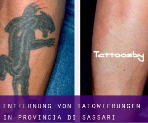 Entfernung von Tätowierungen in Provincia di Sassari