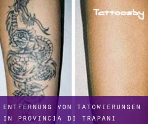 Entfernung von Tätowierungen in Provincia di Trapani