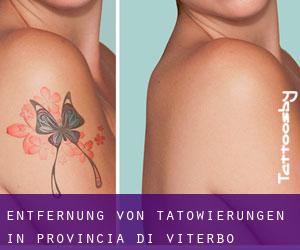 Entfernung von Tätowierungen in Provincia di Viterbo