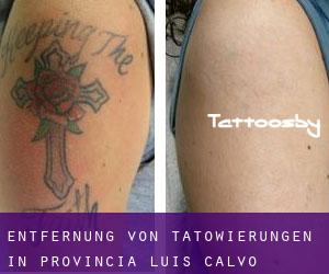 Entfernung von Tätowierungen in Provincia Luis Calvo