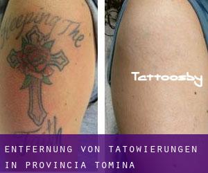 Entfernung von Tätowierungen in Provincia Tomina