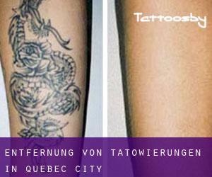 Entfernung von Tätowierungen in Quebec City