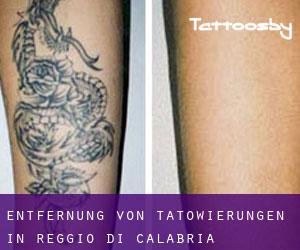 Entfernung von Tätowierungen in Reggio di Calabria