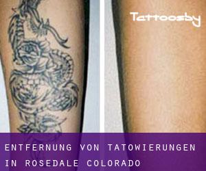 Entfernung von Tätowierungen in Rosedale (Colorado)