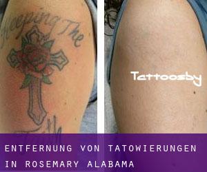 Entfernung von Tätowierungen in Rosemary (Alabama)