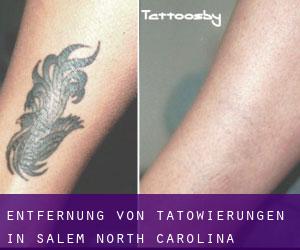 Entfernung von Tätowierungen in Salem (North Carolina)