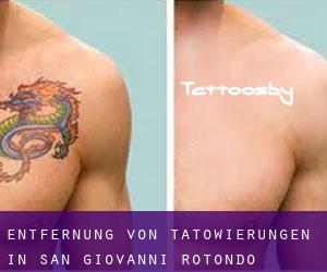 Entfernung von Tätowierungen in San Giovanni Rotondo