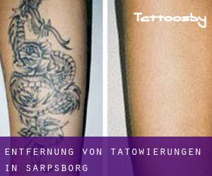 Entfernung von Tätowierungen in Sarpsborg