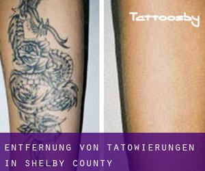 Entfernung von Tätowierungen in Shelby County