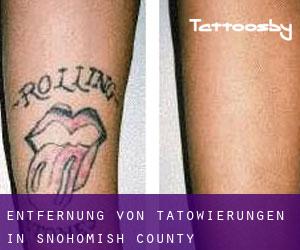 Entfernung von Tätowierungen in Snohomish County