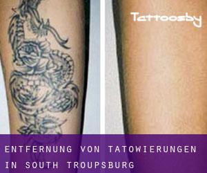 Entfernung von Tätowierungen in South Troupsburg