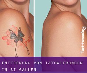 Entfernung von Tätowierungen in St. Gallen