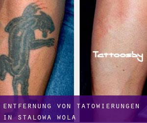 Entfernung von Tätowierungen in Stalowa Wola