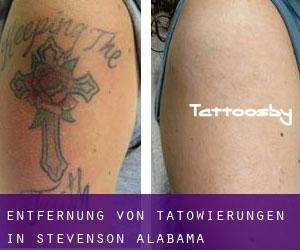 Entfernung von Tätowierungen in Stevenson (Alabama)