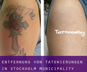 Entfernung von Tätowierungen in Stockholm municipality
