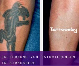 Entfernung von Tätowierungen in Strausberg