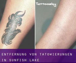Entfernung von Tätowierungen in Sunfish Lake