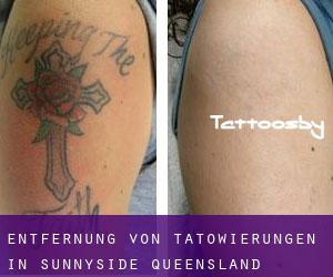 Entfernung von Tätowierungen in Sunnyside (Queensland)