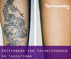 Entfernung von Tätowierungen in Taguatinga