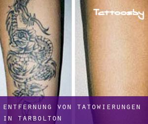 Entfernung von Tätowierungen in Tarbolton