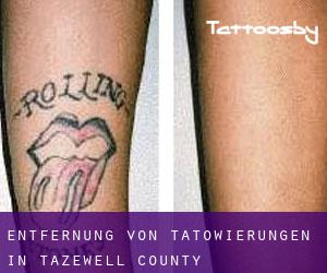 Entfernung von Tätowierungen in Tazewell County