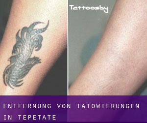 Entfernung von Tätowierungen in Tepetate