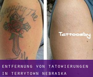 Entfernung von Tätowierungen in Terrytown (Nebraska)