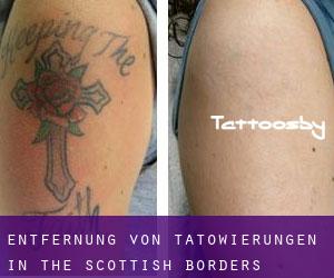 Entfernung von Tätowierungen in The Scottish Borders