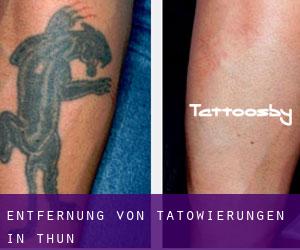 Entfernung von Tätowierungen in Thun