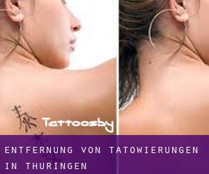Entfernung von Tätowierungen in Thüringen
