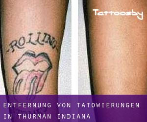 Entfernung von Tätowierungen in Thurman (Indiana)