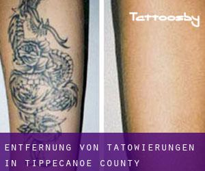 Entfernung von Tätowierungen in Tippecanoe County