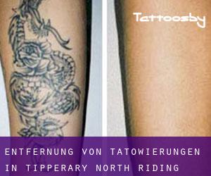 Entfernung von Tätowierungen in Tipperary North Riding